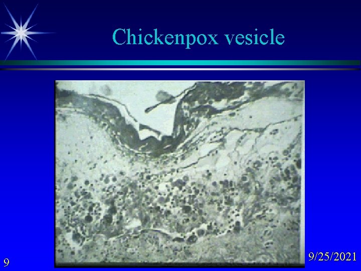 Chickenpox vesicle 9 9/25/2021 