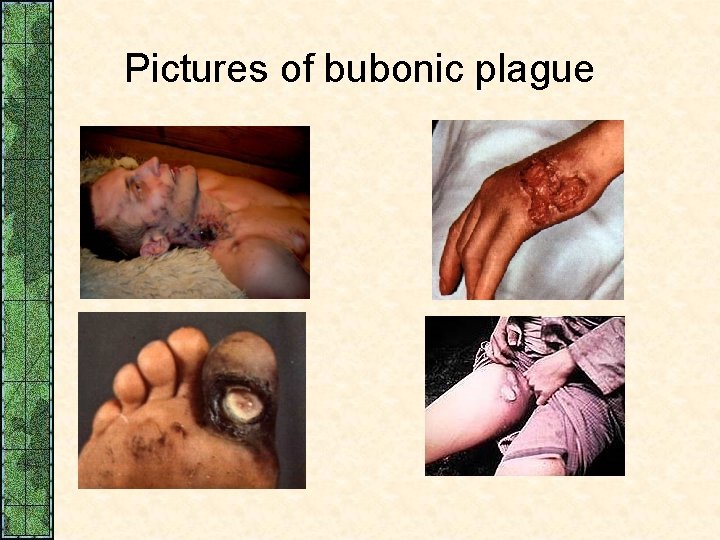 Pictures of bubonic plague 