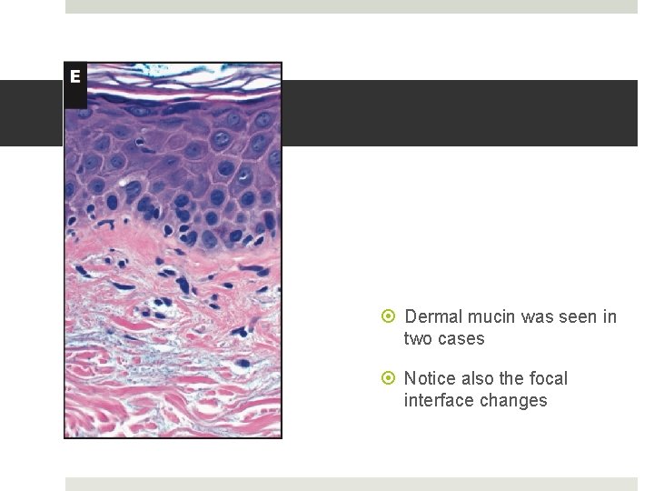  Dermal mucin was seen in two cases Notice also the focal interface changes
