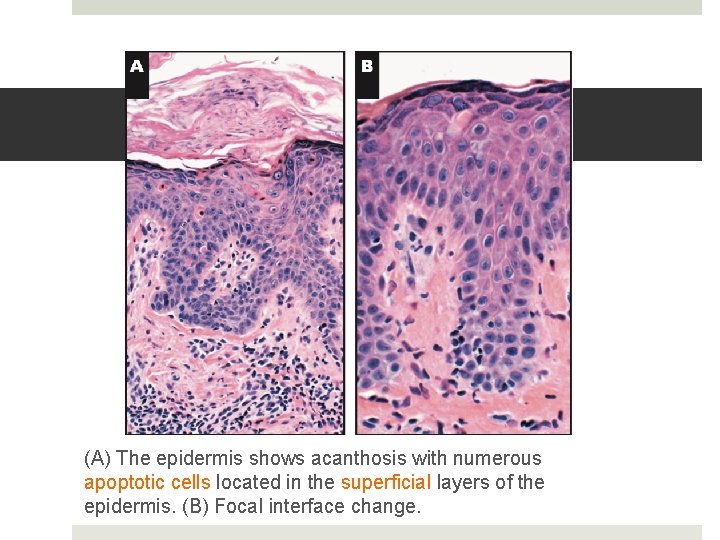 (A) The epidermis shows acanthosis with numerous apoptotic cells located in the superficial layers