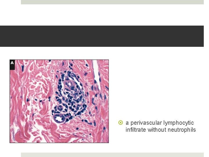  a perivascular lymphocytic infiltrate without neutrophils 
