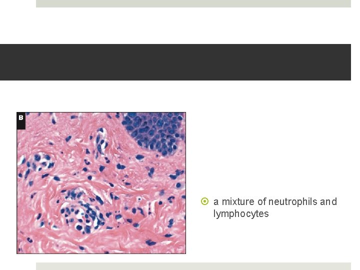  a mixture of neutrophils and lymphocytes 