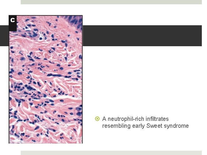  A neutrophil-rich infiltrates resembling early Sweet syndrome 