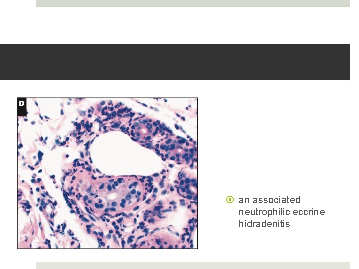  an associated neutrophilic eccrine hidradenitis 