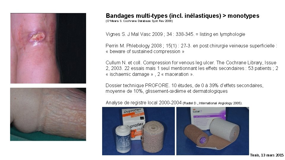 Bandages multi-types (incl. inélastiques) > monotypes (O’Meara S. Cochrane Database Syst Rev 2009) Vignes