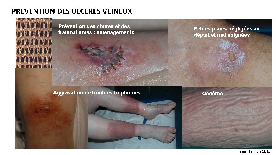 PREVENTION DES ULCERES VEINEUX Prévention des chutes et des traumatismes : aménagements Aggravation de