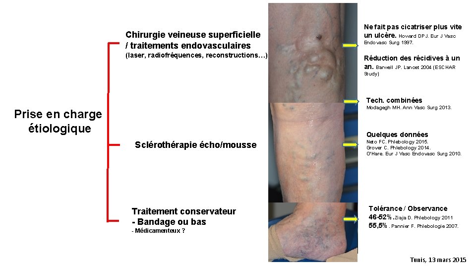 Chirurgie veineuse superficielle / traitements endovasculaires (laser, radiofréquences, reconstructions…) Ne fait pas cicatriser plus