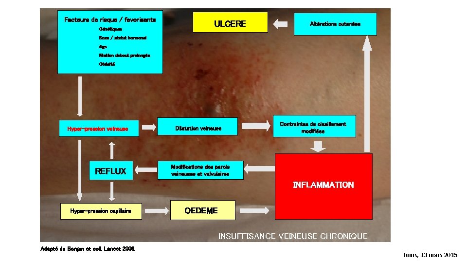 Facteurs de risque / favorisants Génétiques ULCERE Altérations cutanées Sexe / statut hormonal Age