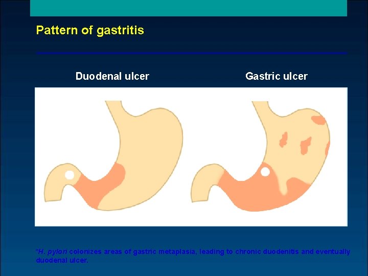 Pattern of gastritis Duodenal ulcer Gastric ulcer Corpusitis * Antral gastritis *H. pylori colonizes