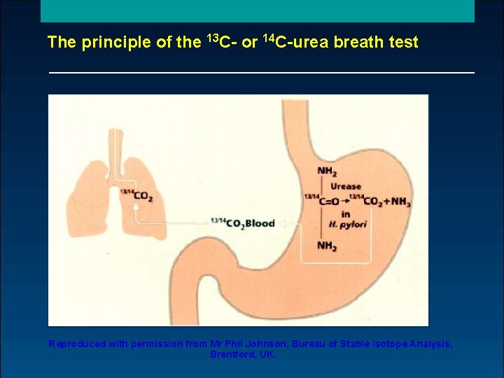 The principle of the 13 C- or 14 C-urea breath test Reproduced with permission