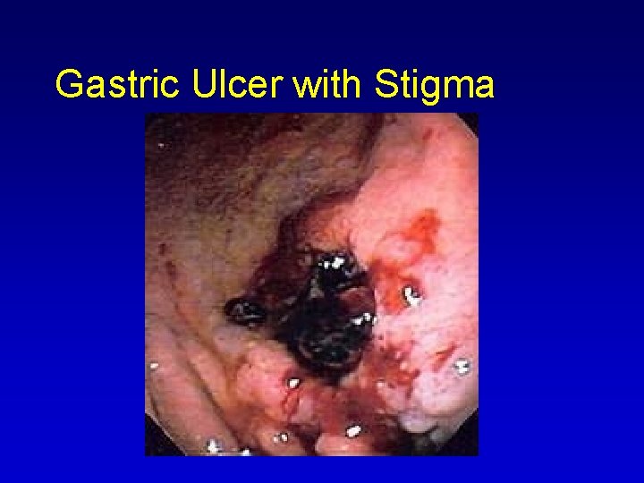 Gastric Ulcer with Stigma 