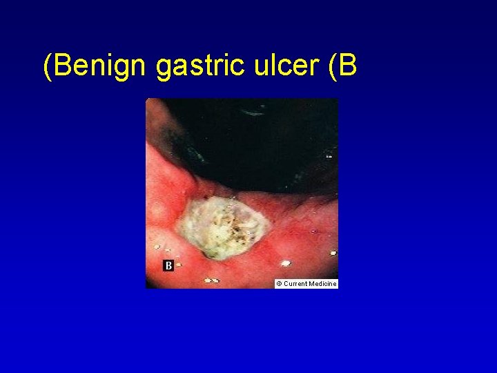 (Benign gastric ulcer (B 