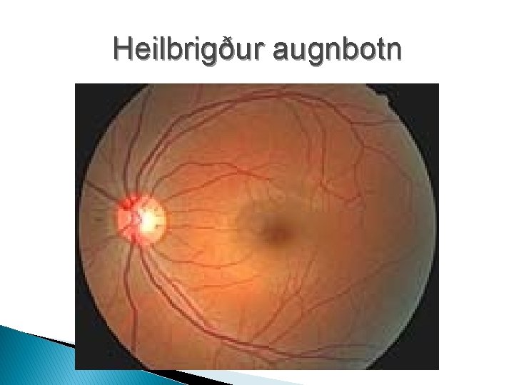 Heilbrigður augnbotn 