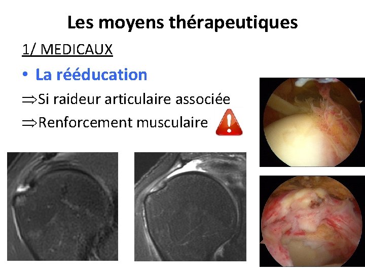 Les moyens thérapeutiques 1/ MEDICAUX • La rééducation Si raideur articulaire associée Renforcement musculaire