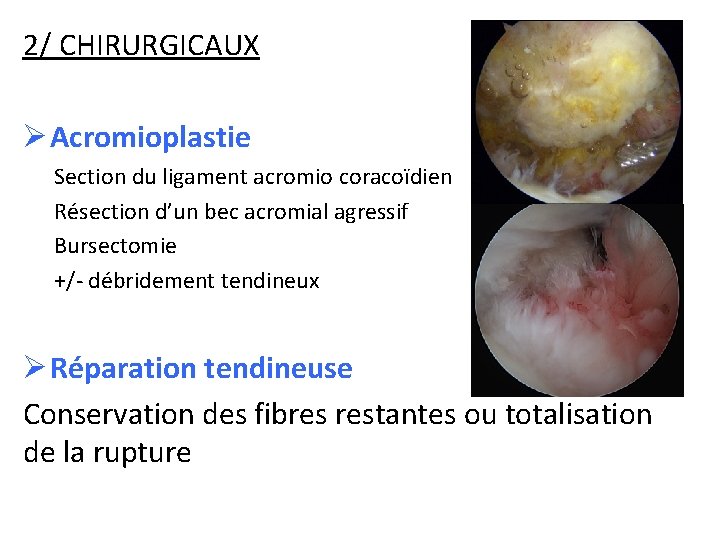 2/ CHIRURGICAUX Ø Acromioplastie Section du ligament acromio coracoïdien Résection d’un bec acromial agressif