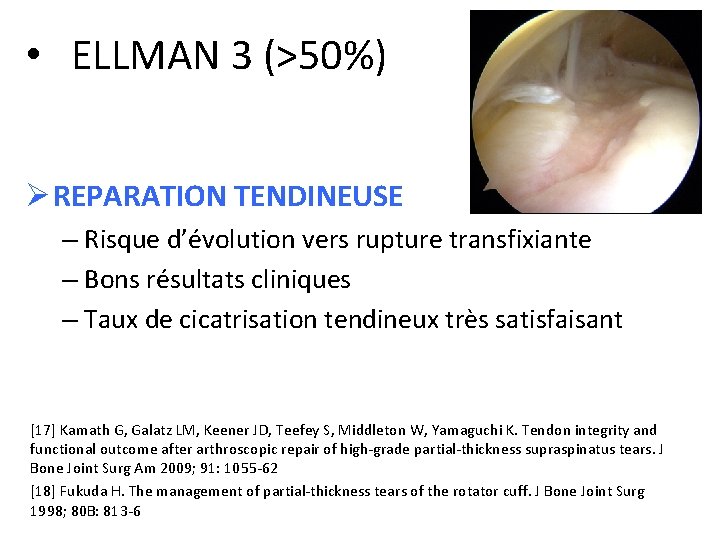  • ELLMAN 3 (>50%) Ø REPARATION TENDINEUSE – Risque d’évolution vers rupture transfixiante