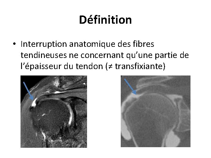 Définition • Interruption anatomique des fibres tendineuses ne concernant qu’une partie de l’épaisseur du