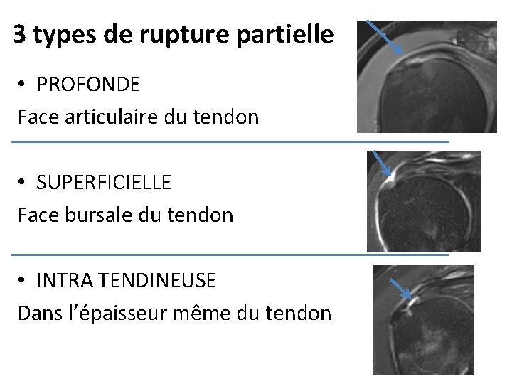 3 types de rupture partielle • PROFONDE Face articulaire du tendon • SUPERFICIELLE Face