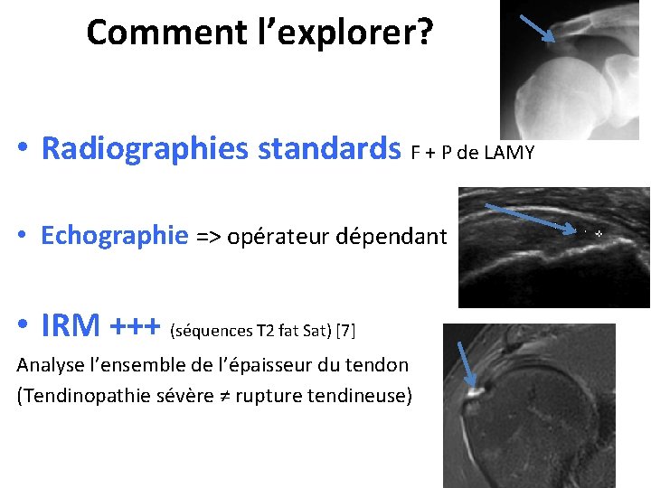 Comment l’explorer? • Radiographies standards F + P de LAMY • Echographie => opérateur