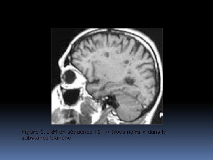 Figure 1. IRM en séquence T 1 : « trous noirs » dans la