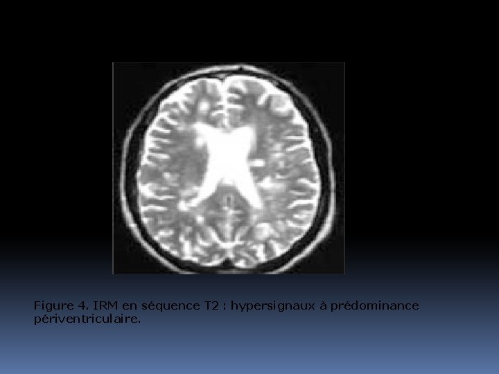 Figure 4. IRM en séquence T 2 : hypersignaux à prédominance périventriculaire. 