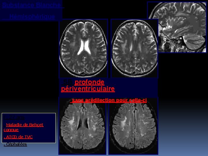 Substance Blanche Hémisphérique SB profonde périventriculaire sans prédilection pour celle-ci F, 27 ans. Maladie