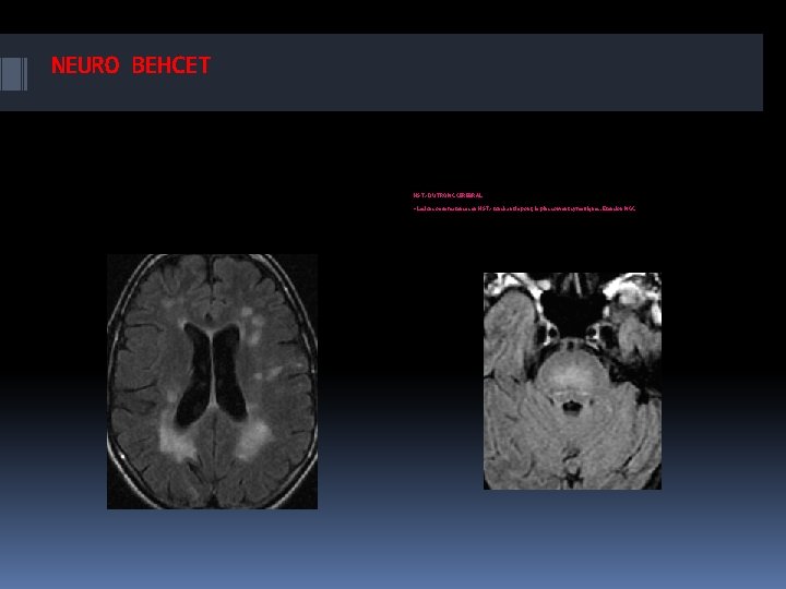 NEURO BEHCET HS T 2 DU TRONC CEREBRAL • Lesions oedemateuses en HS T