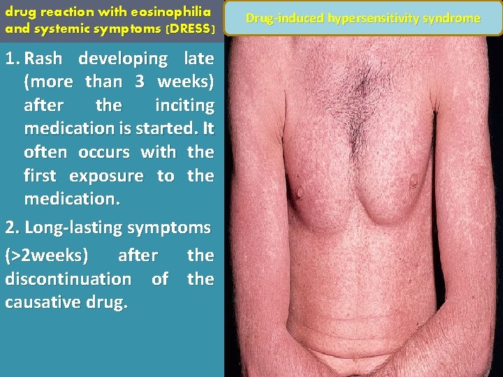 drug reaction with eosinophilia and systemic symptoms (DRESS) 1. Rash developing late (more than