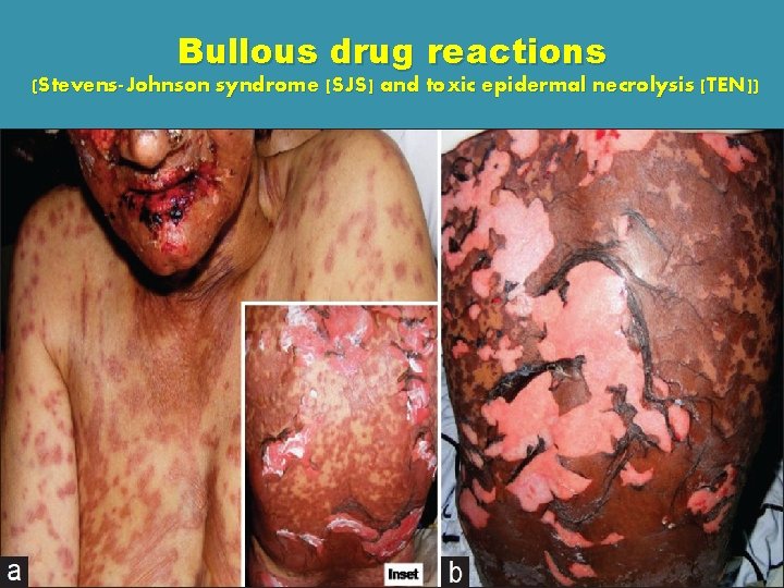 Bullous drug reactions (Stevens-Johnson syndrome [SJS] and toxic epidermal necrolysis [TEN]) 