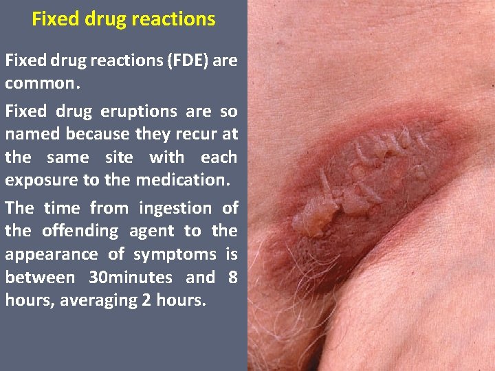 Fixed drug reactions (FDE) are common. Fixed drug eruptions are so named because they