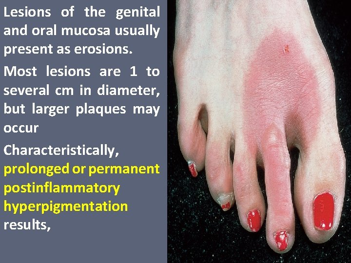 Lesions of the genital and oral mucosa usually present as erosions. Most lesions are