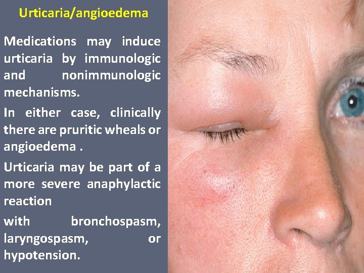 Urticaria/angioedema Medications may induce urticaria by immunologic and nonimmunologic mechanisms. In either case, clinically