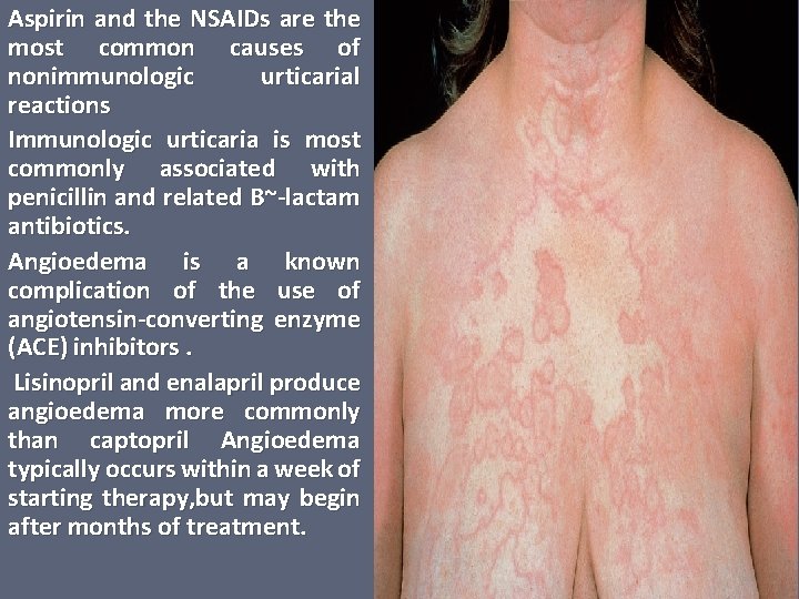 Aspirin and the NSAIDs are the most common causes of nonimmunologic urticarial reactions Immunologic