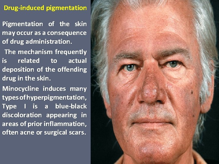 Drug-induced pigmentation Pigmentation of the skin may occur as a consequence of drug administration.