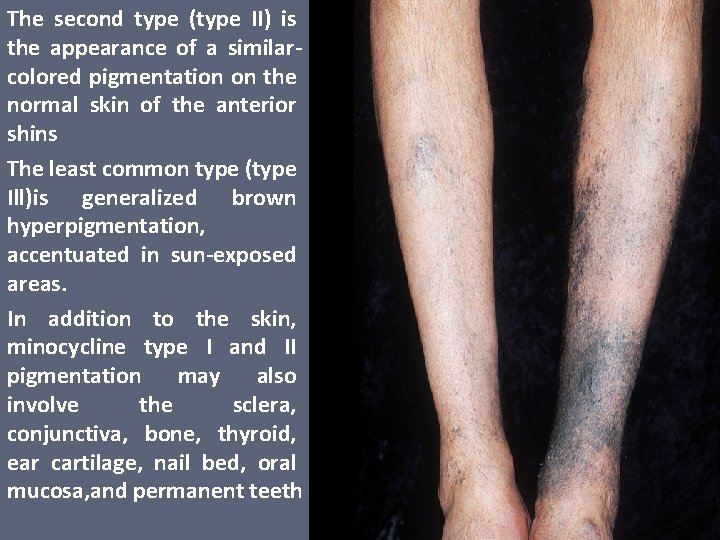 The second type (type II) is the appearance of a similarcolored pigmentation on the