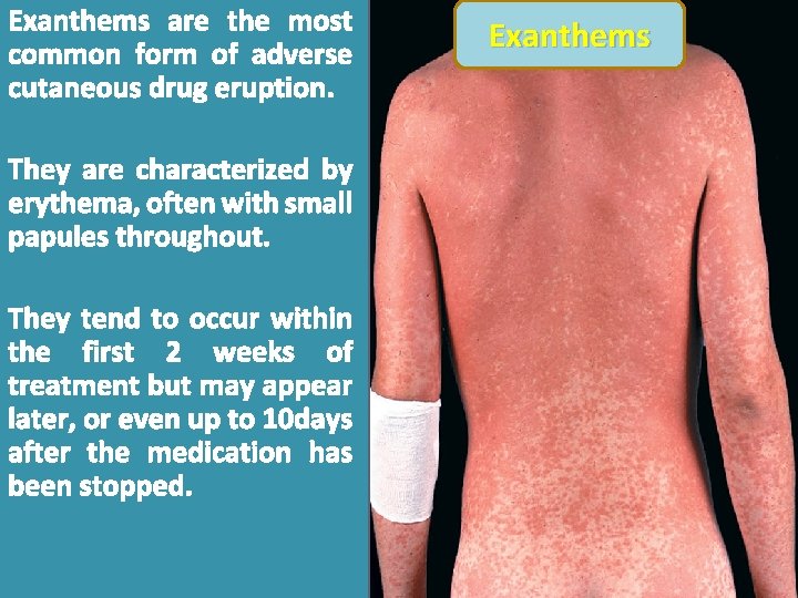 Exanthems are the most common form of adverse cutaneous drug eruption. They are characterized