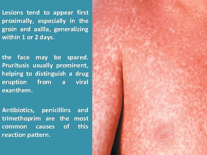 Lesions tend to appear first proximally, especially in the groin and axilla, generalizing within