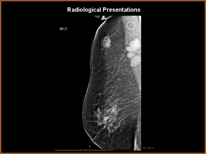 Radiological Presentations MLO 