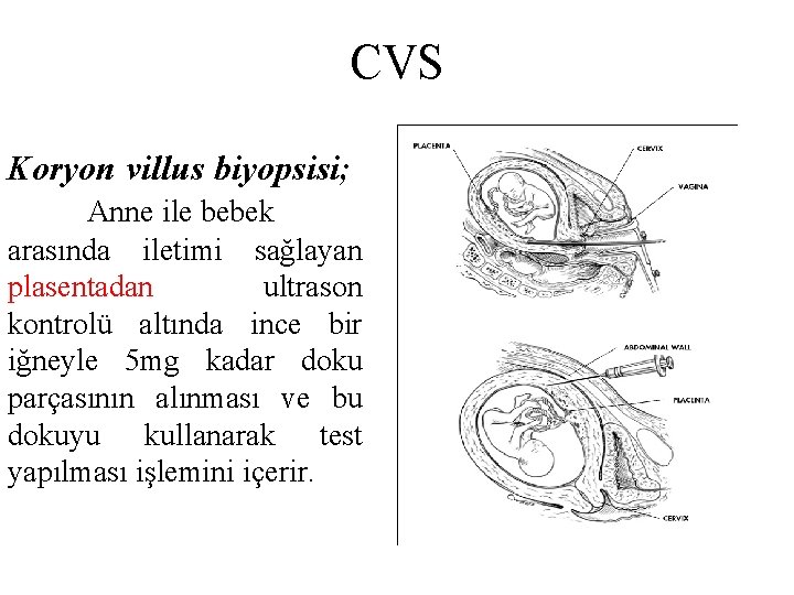 CVS Koryon villus biyopsisi; Anne ile bebek arasında iletimi sağlayan plasentadan ultrason kontrolü altında