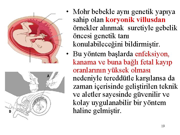  • Mohr bebekle aynı genetik yapıya sahip olan koryonik villusdan örnekler alınmak suretiyle