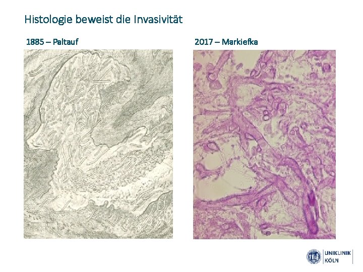 Histologie beweist die Invasivität 1885 – Paltauf 2017 – Markiefka 