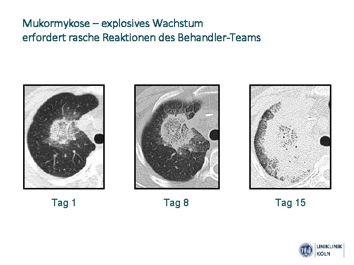 Mukormykose – explosives Wachstum erfordert rasche Reaktionen des Behandler-Teams Tag 1 Tag 8 Tag