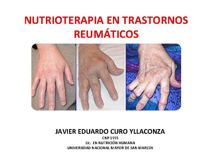 NUTRIOTERAPIA EN TRASTORNOS REUMÁTICOS JAVIER EDUARDO CURO YLLACONZA CNP 1555 Lic. EN NUTRICIÓN HUMANA