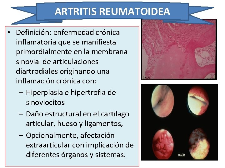 ARTRITIS REUMATOIDEA • Definición: enfermedad crónica inflamatoria que se manifiesta primordialmente en la membrana