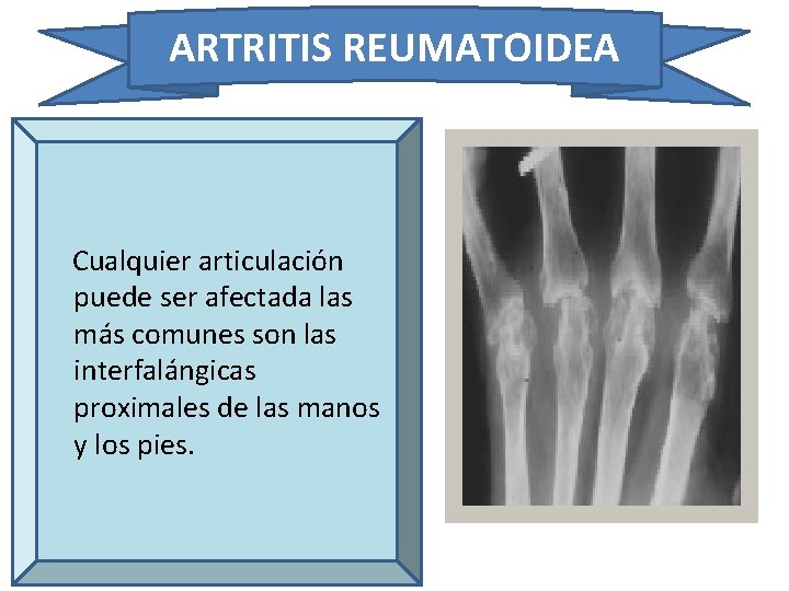 ARTRITIS REUMATOIDEA Cualquier articulación puede ser afectada las más comunes son las interfalángicas proximales