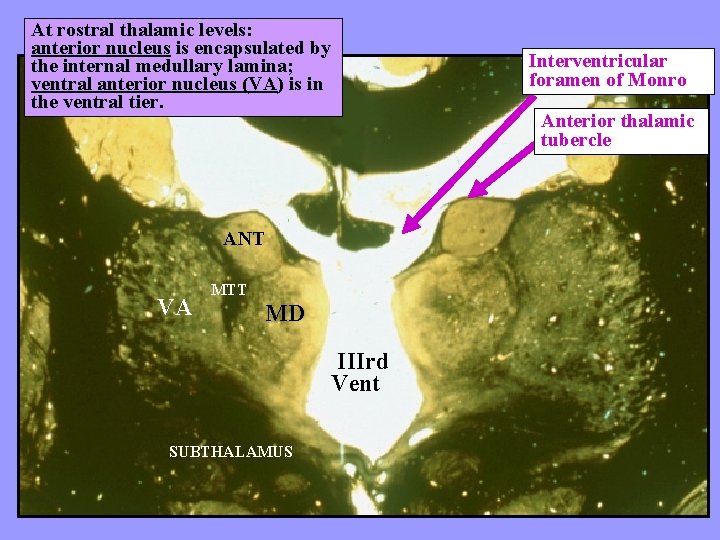 At rostral thalamic levels: anterior nucleus is encapsulated by the internal medullary lamina; ventral