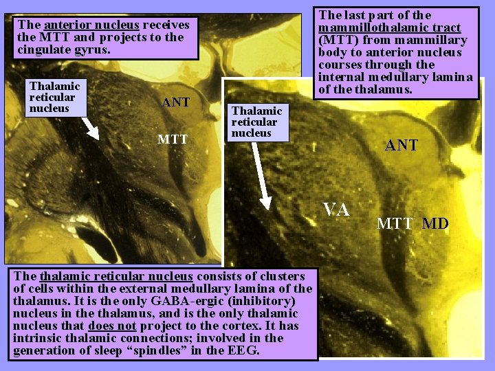 The last part of the mammillothalamic tract (MTT) from mammillary body to anterior nucleus