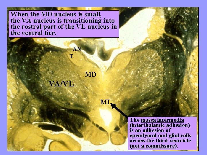 When the MD nucleus is small, the VA nucleus is transitioning into the rostral