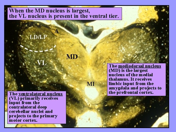 When the MD nucleus is largest, the VL nucleus is present in the ventral
