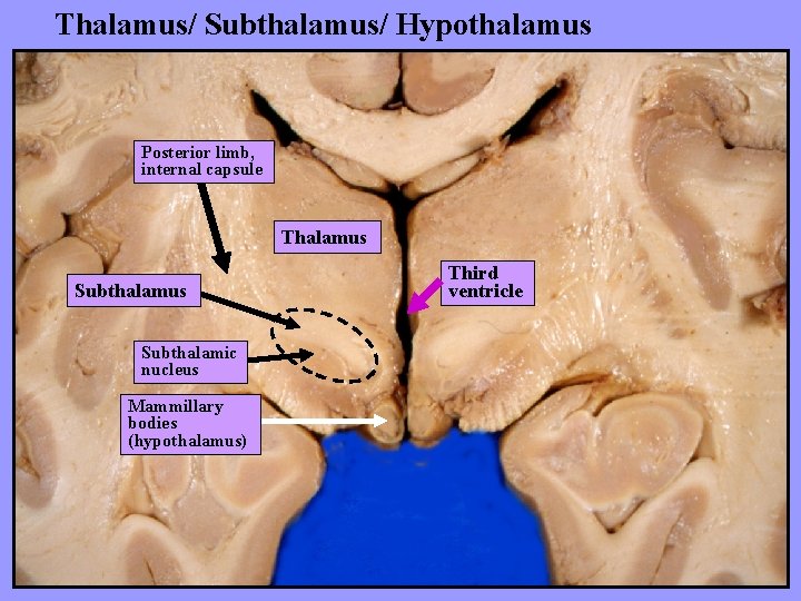 Thalamus/ Subthalamus/ Hypothalamus Posterior limb, internal capsule Thalamus Subthalamic nucleus Mammillary bodies (hypothalamus) Third